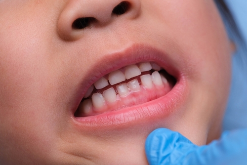 Common Gum Issues in Children and How to Treat Them