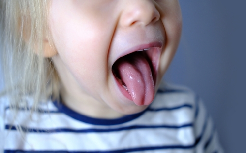 What is a Tongue Tie and How Do You Treat It?