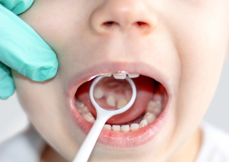 How Do You Know If Your Child Has Cavities?