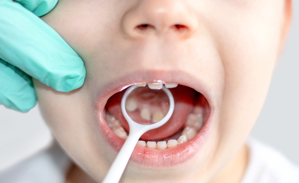 How Do You Know If Your Child Has Cavities?