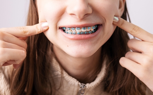 Can You Switch Orthodontists Mid-Treatment?