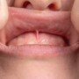 Should You Treat Your Child’s Lip Tie?