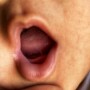 Should You Treat Your Child’s Tongue Tie?
