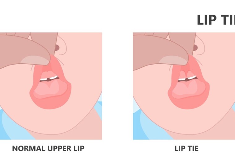 Lip Tie Symptoms & Treatments – A Complete Guide for Parents