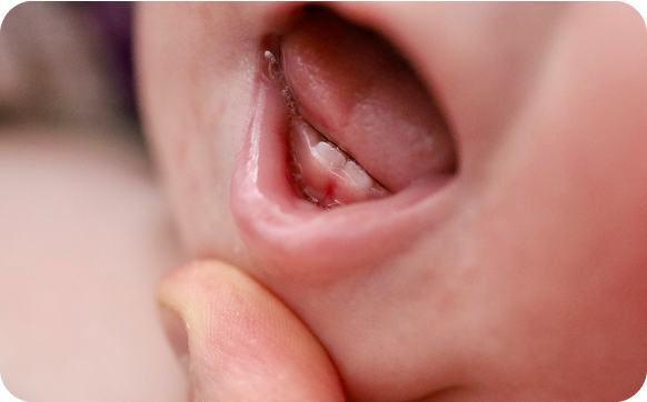 Imge for Injuries to Baby Incisors
