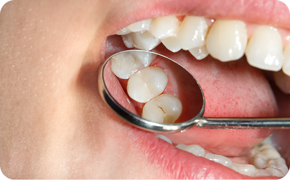 Imge for Protective Pit
& Fissure Sealants