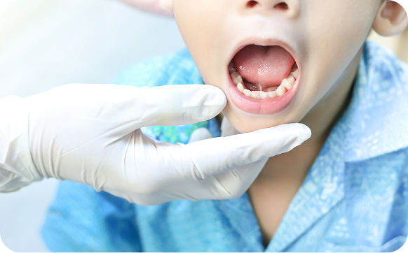 Imge for Tongue & Lip Tie Release Post-Operative Instructions