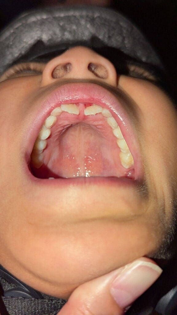 Shark teeth in a child after extraction, adult tooth behind baby teeth
