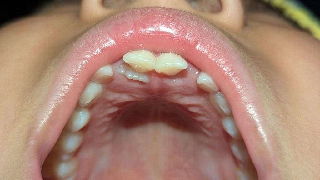 Shark teeth in a child before extraction, adult tooth behind baby teeth